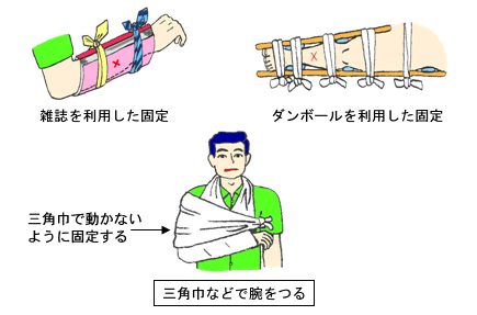 雑誌を利用した固定　ダンボールを利用した固定　三角巾などで腕をつる　三角巾で動かないように固定する